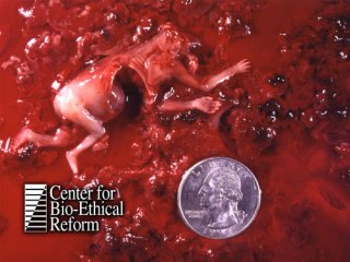 Inilah yang Terjadi Pada Bayi yang di-Aborsi (Hentikan Aborsi!)(DP inside!!) 7