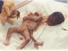 Inilah yang Terjadi Pada Bayi yang di-Aborsi (Hentikan Aborsi!)(DP inside!!) 8